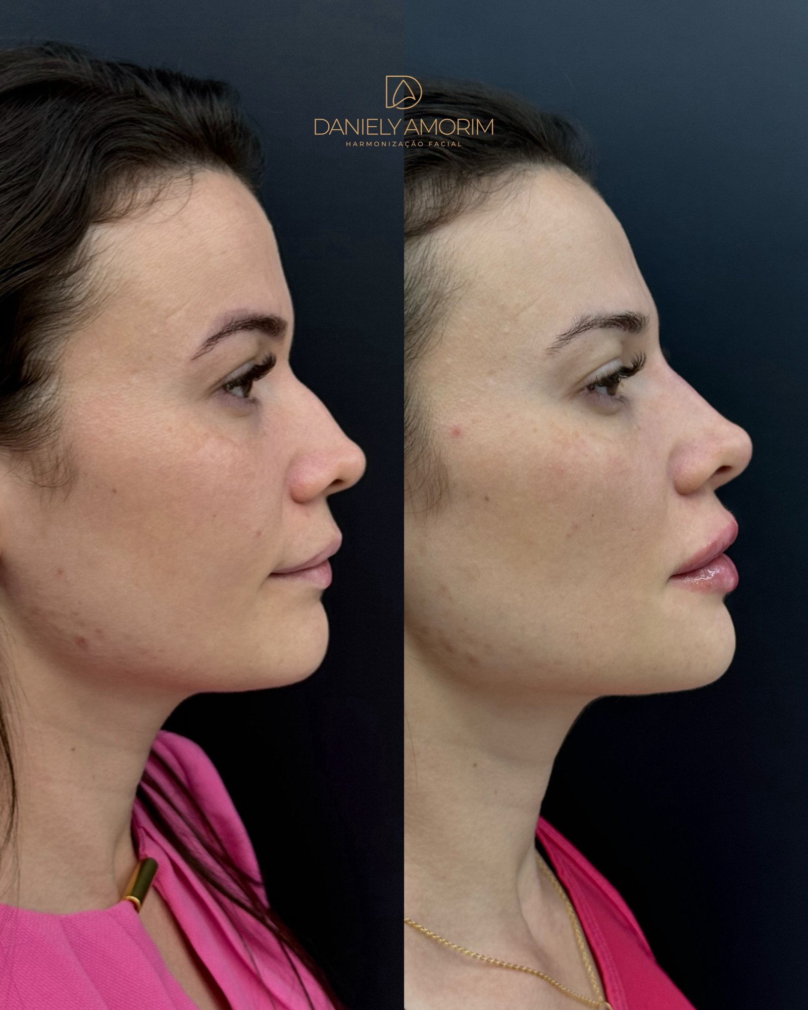 Antes e depois de harmonização facial de perfil, destacando a correção do nariz (rinomodelação) e projeção do queixo (mento) com naturalidade.
