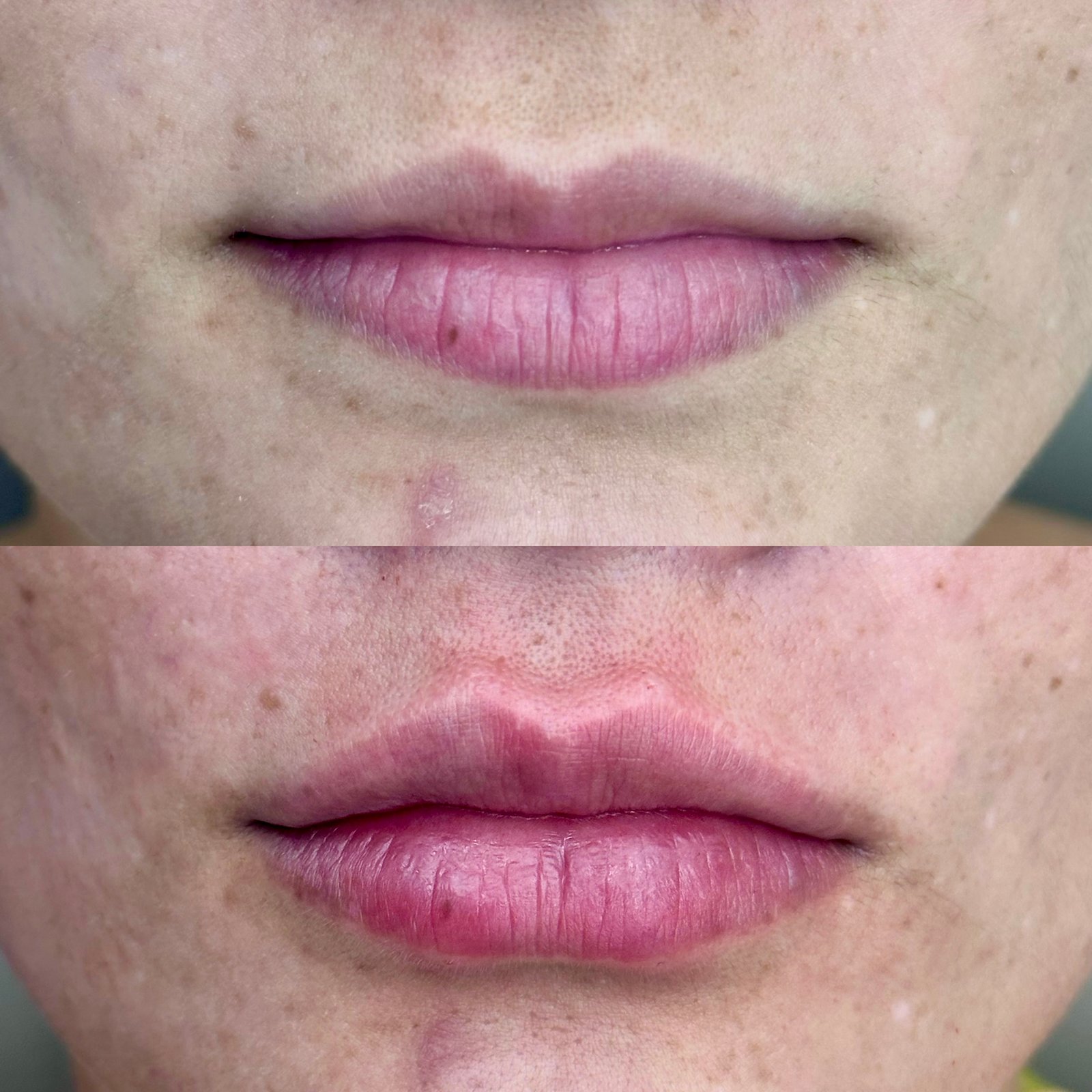 Comparativo de preenchimento labial (antes e depois) mostrando aumento de volume, hidratação e contorno definido dos lábios.