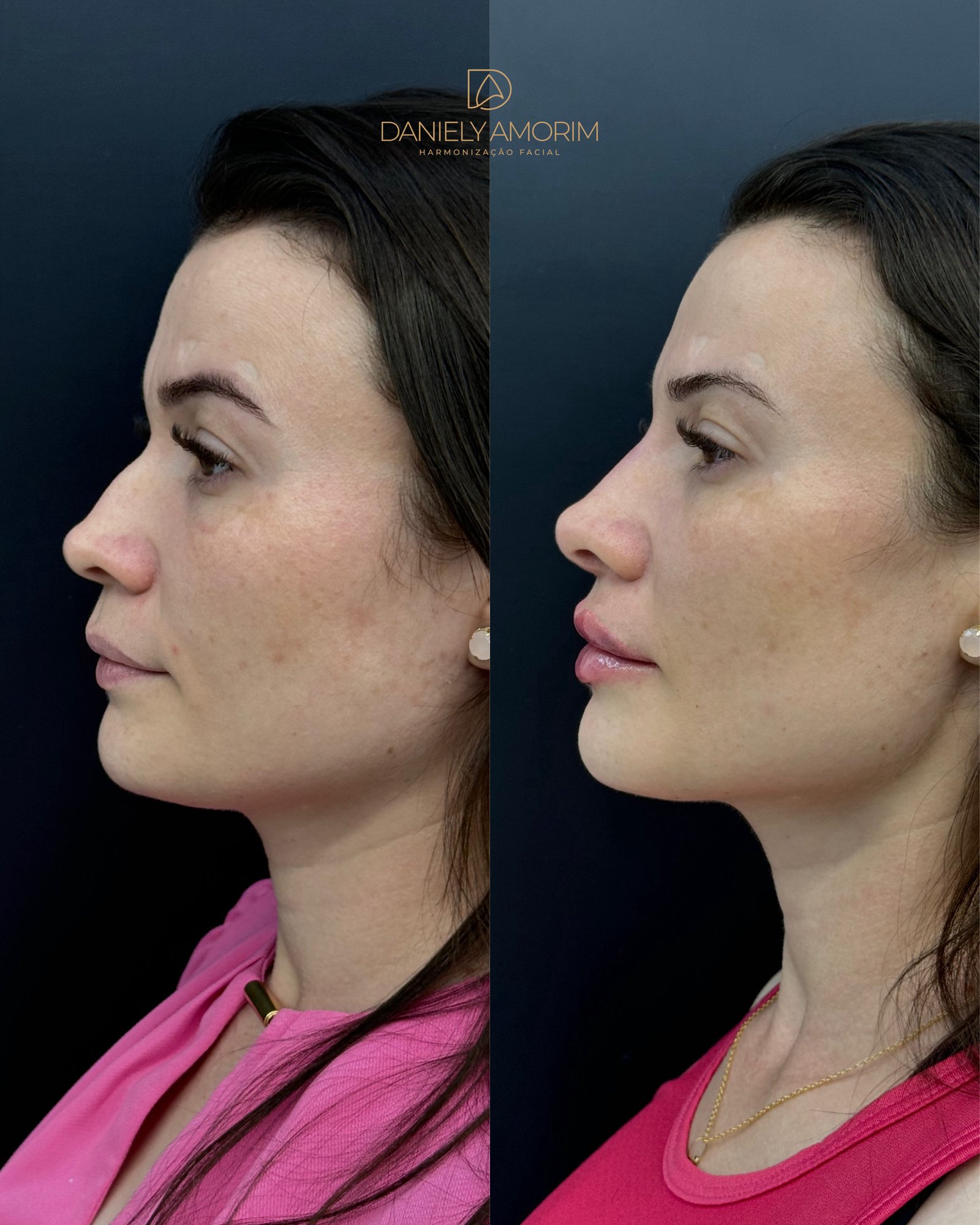 Resultado lateral de harmonização facial realizado pela Dra. Daniely Amorim, evidenciando o equilíbrio entre nariz, lábios e queixo.