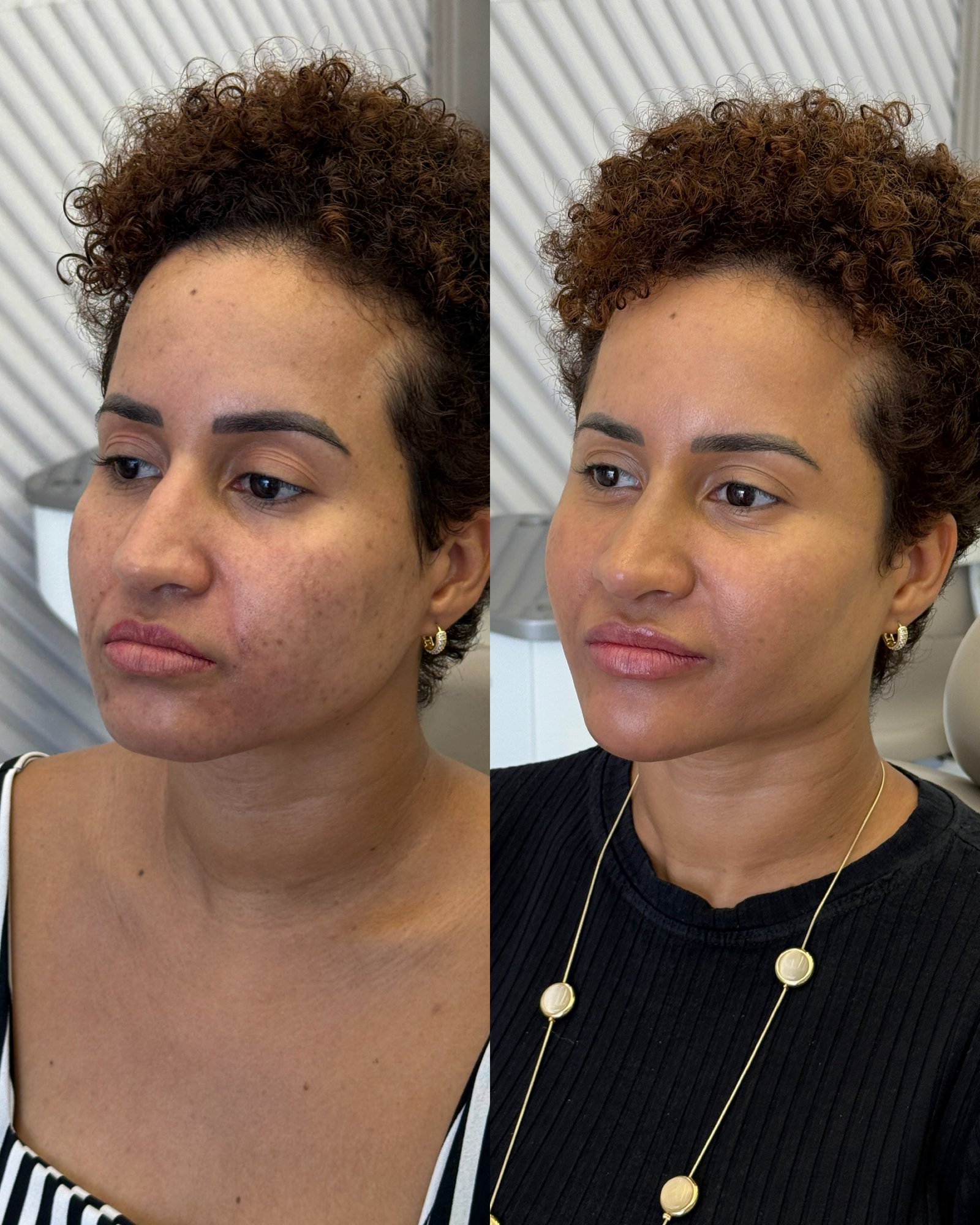 Antes e depois em ângulo 3/4 de paciente, mostrando o efeito 'Top Model Look' com definição de malar e mandíbula.