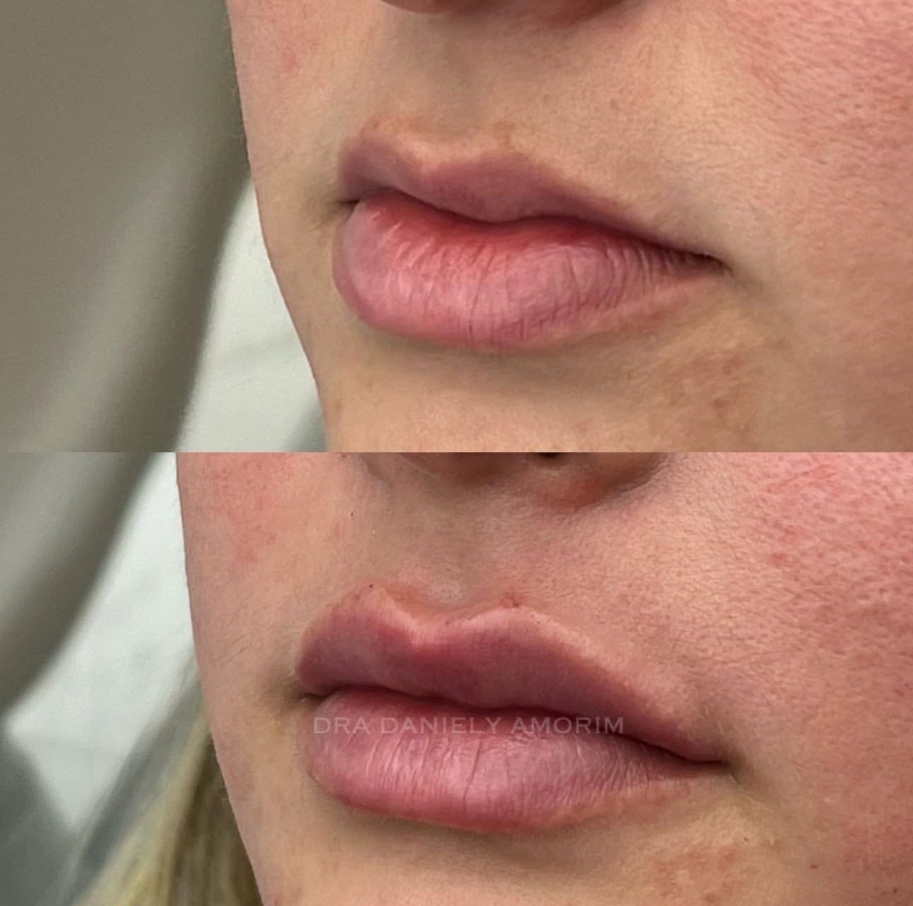 Detalhe de antes e depois de preenchimento labial, corrigindo o 'código de barras' e devolvendo volume aos lábios.