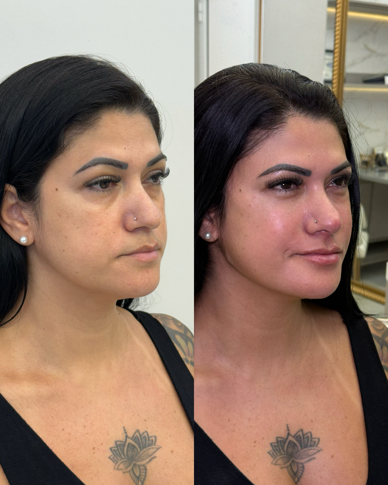 Comparativo de perfil 3/4 mostrando preenchimento de olheiras e estruturação da maçã do rosto (malar) em Rondonópolis.