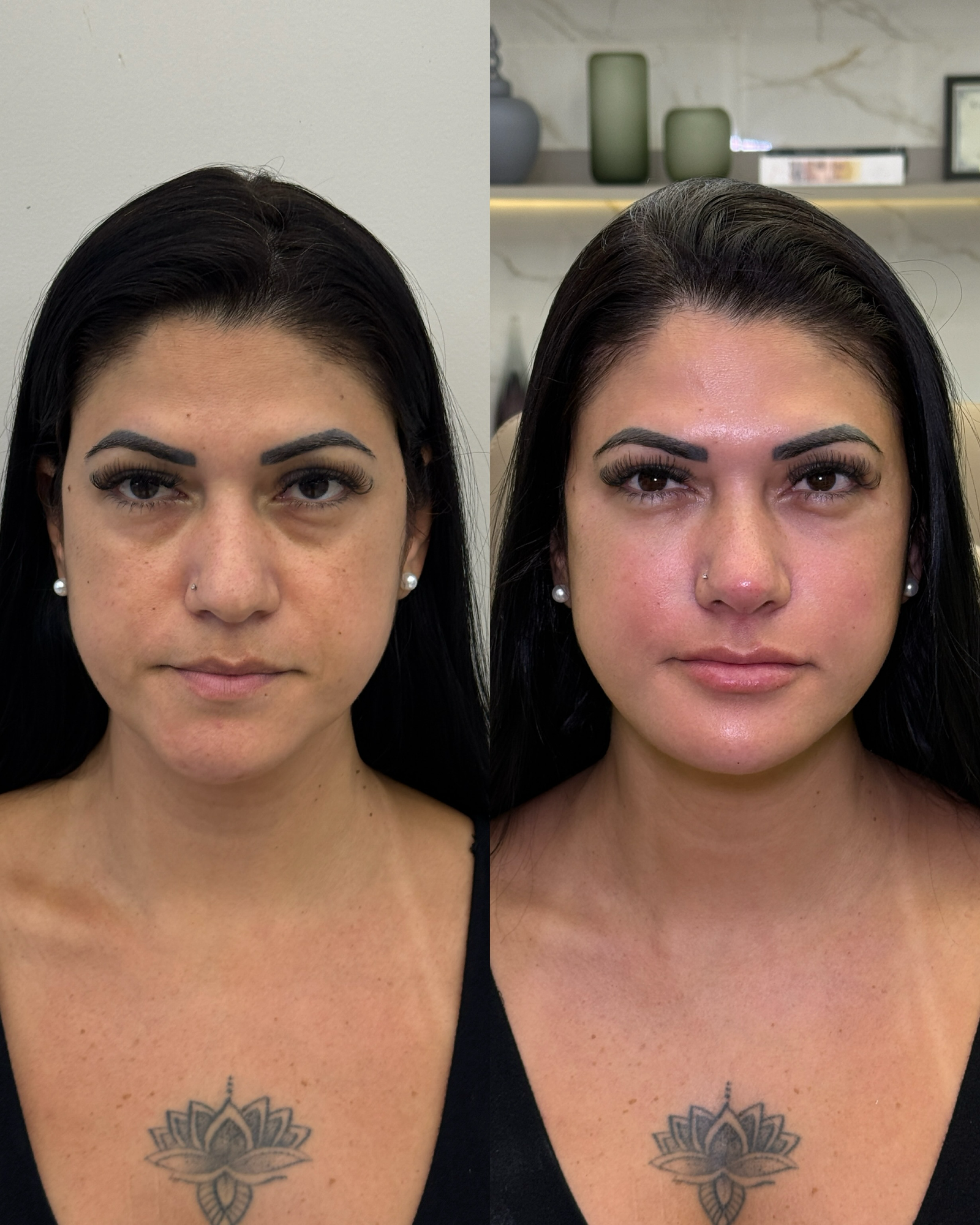 Resultado frontal de harmonização full face, realçando a beleza natural com simetria e rejuvenescimento da pele.