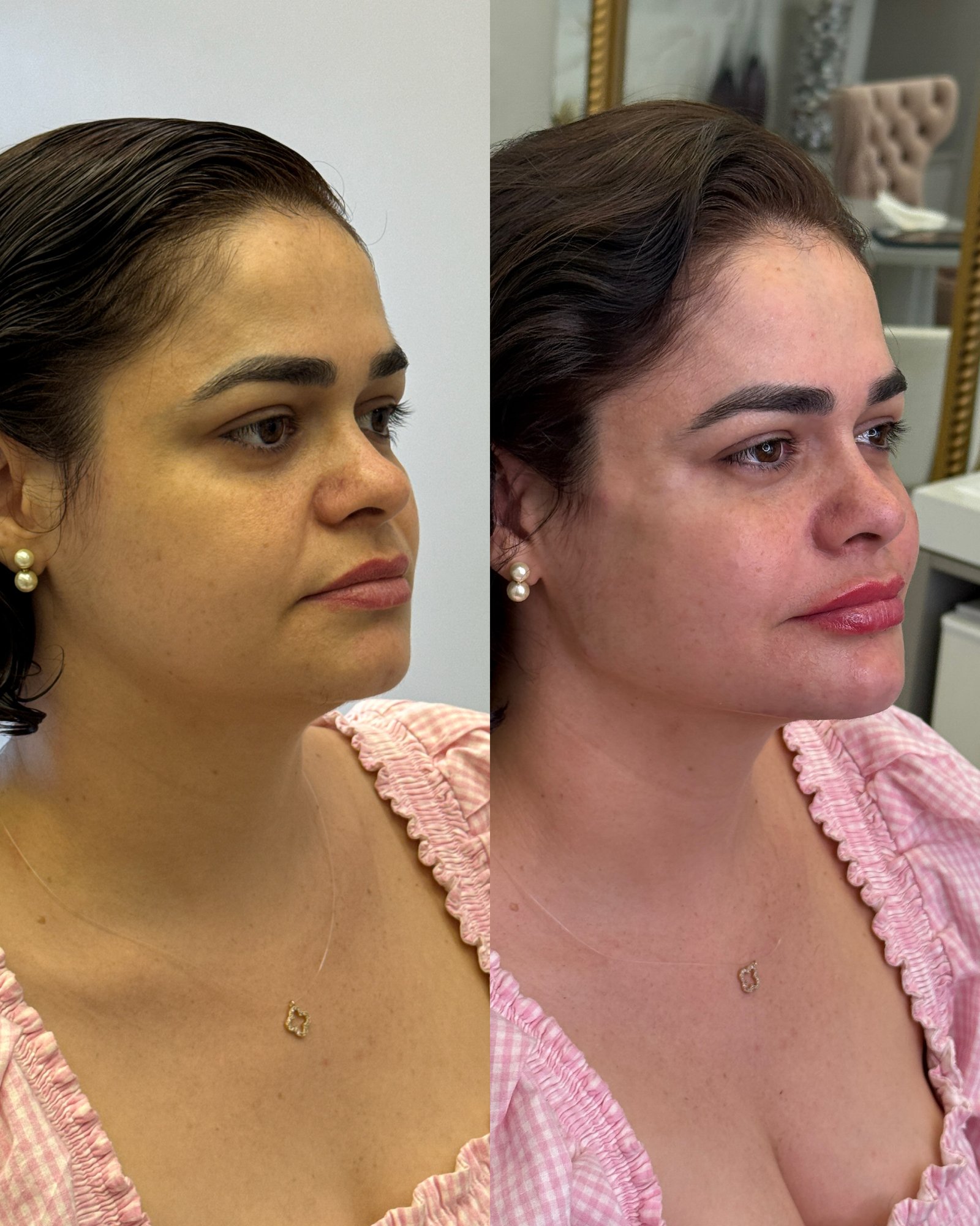 Harmonização facial focada em estruturação: antes e depois mostrando preenchimento de malar (maçãs do rosto) e lábios.