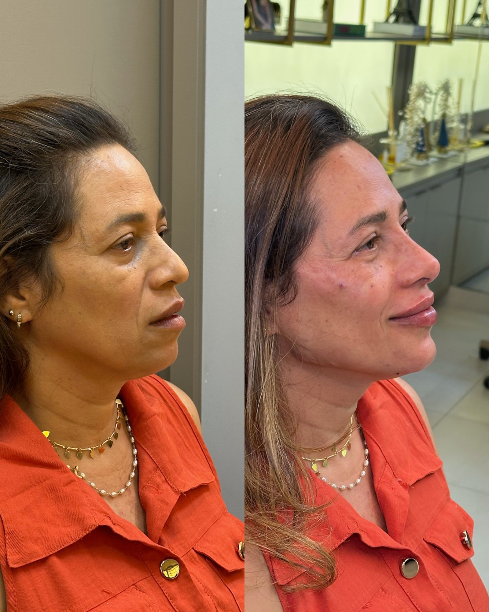 Lifting não cirúrgico em pele madura: perfil comparativo mostrando a suavização de rugas e contorno facial renovado.