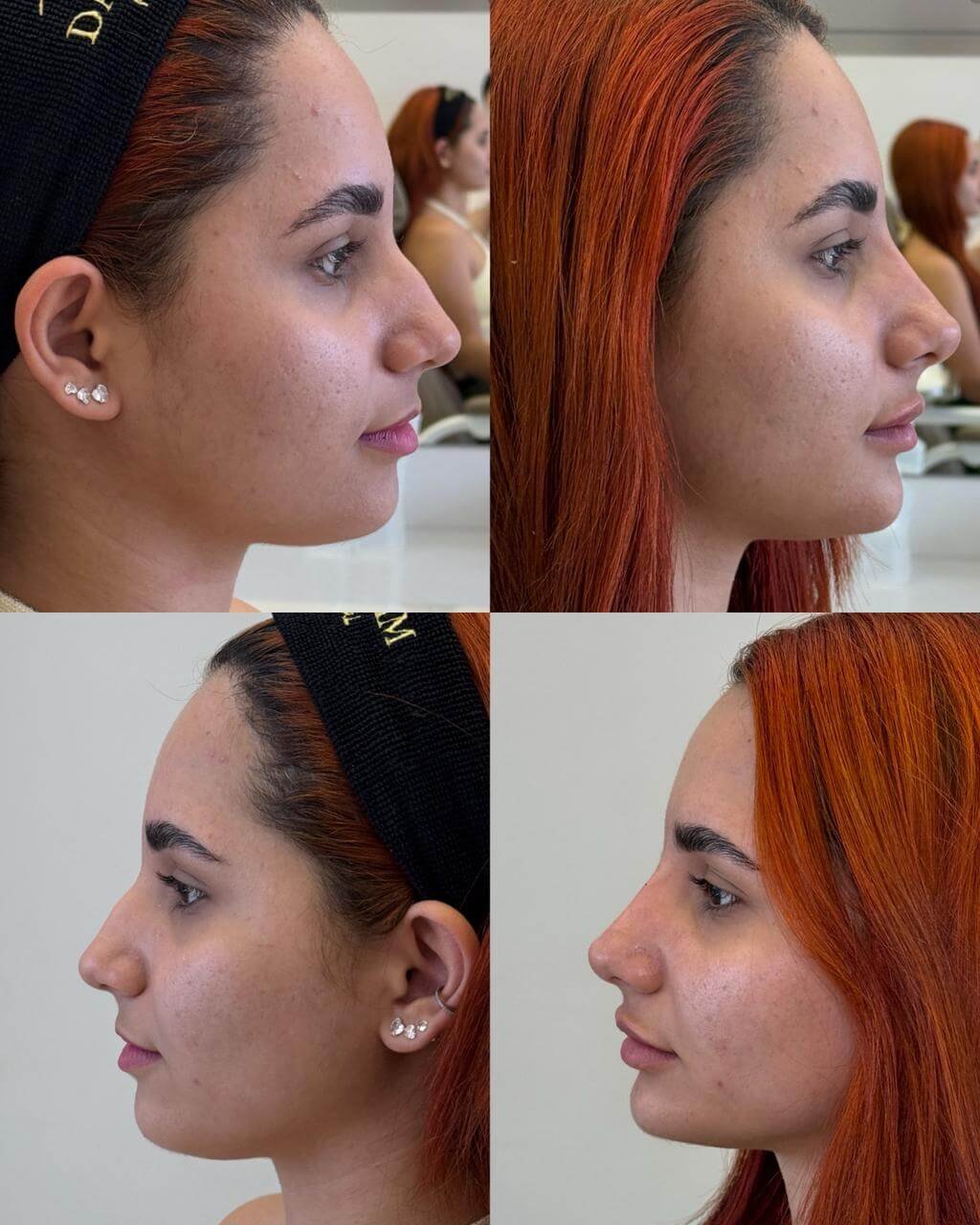 Rinomodelação sem cirurgia: antes e depois de perfil corrigindo o dorso nasal e levantando a ponta do nariz.