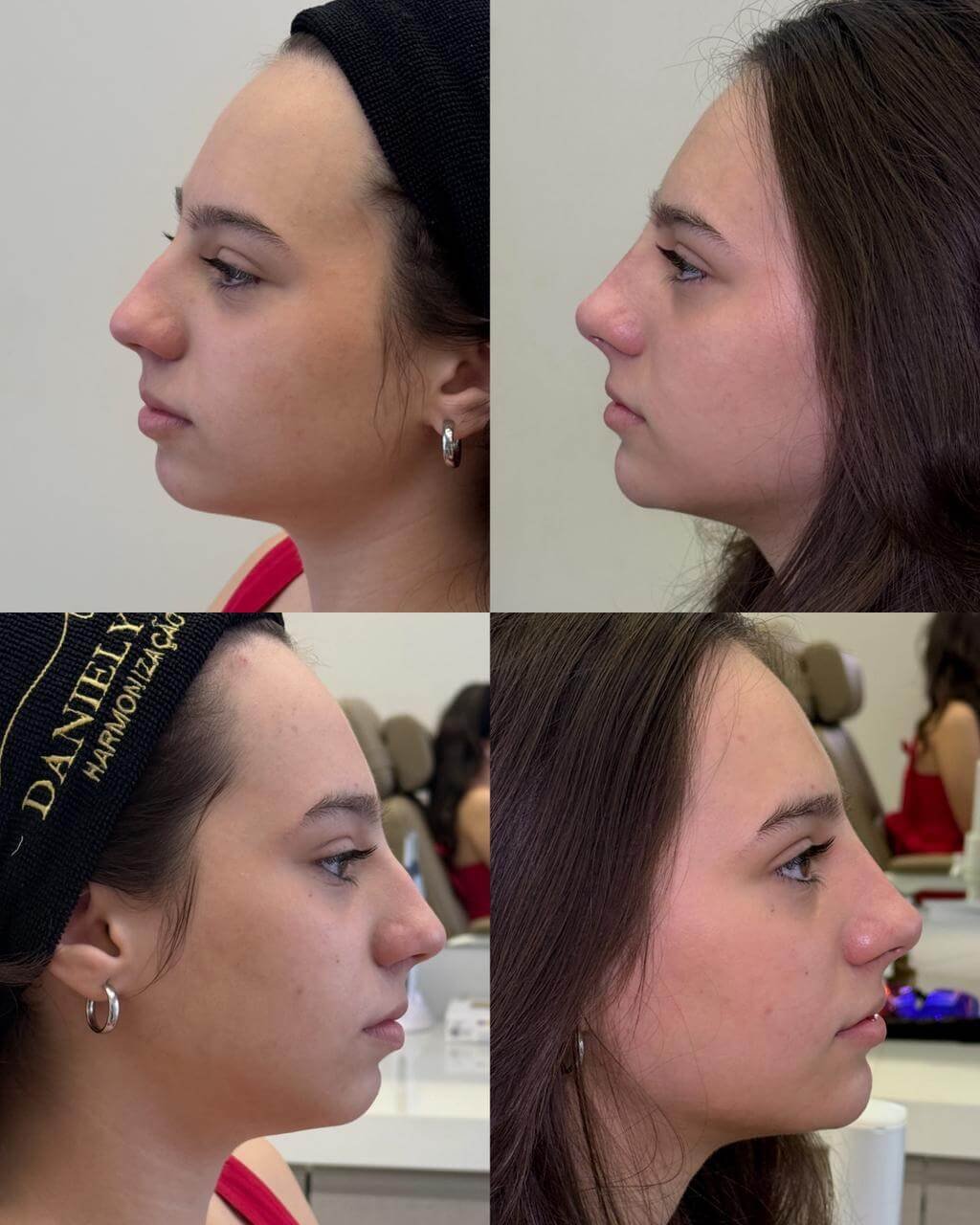 Montagem com 4 fotos de perfil (antes e depois) focada em rinomodelação e projeção labial equilibrada.
